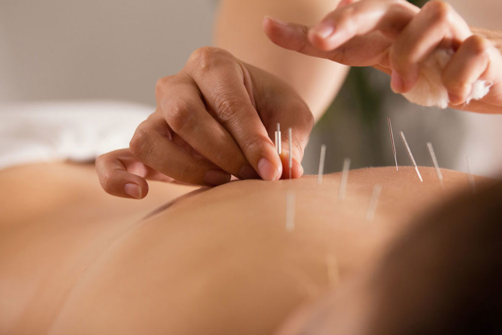 Acupuncture helping with fertility