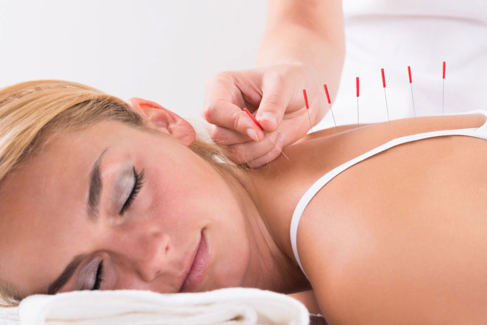 Acupuncture helping with fertility
