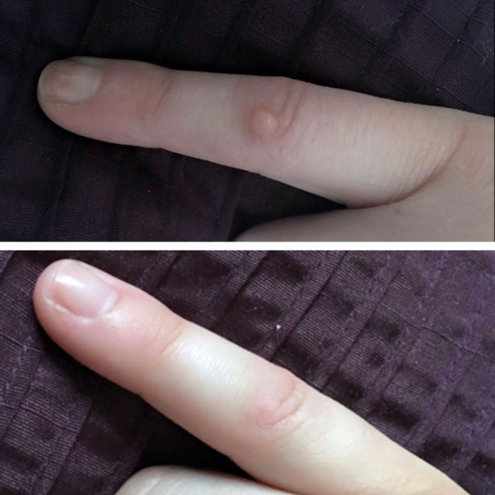 Before and after finger wart removal