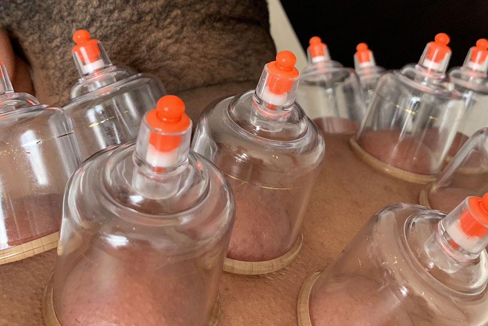 Chinese cupping treatment