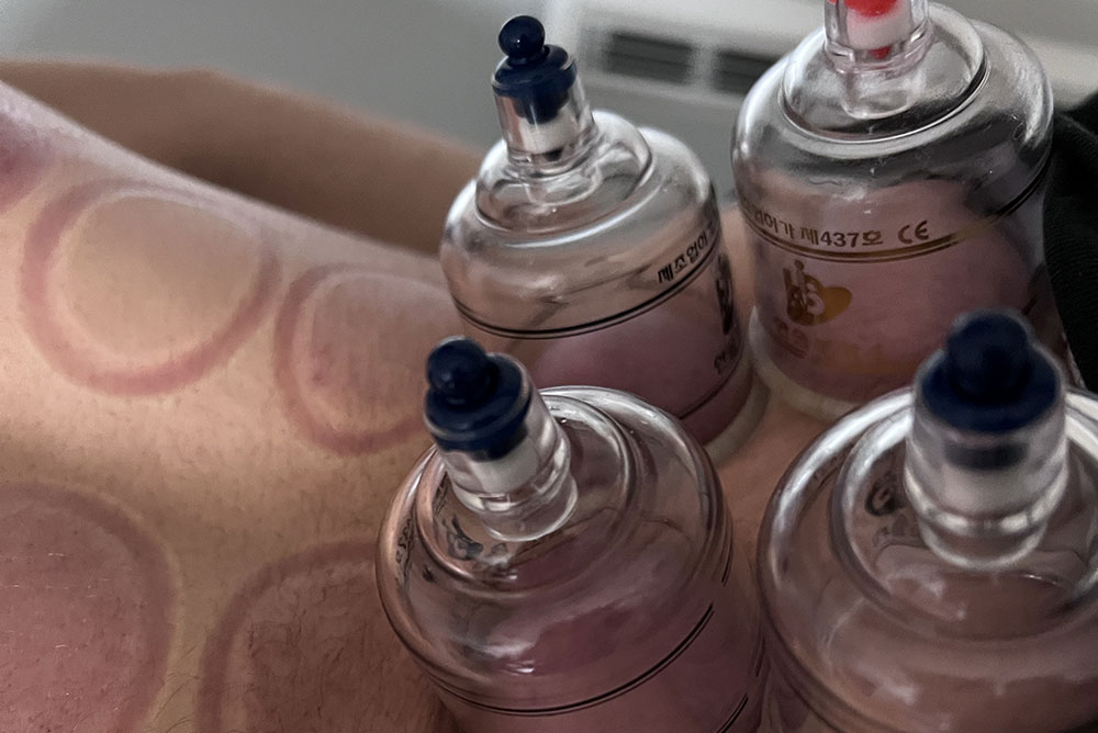 Chinese cupping treatment