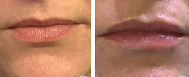 Before and after lip fillers
