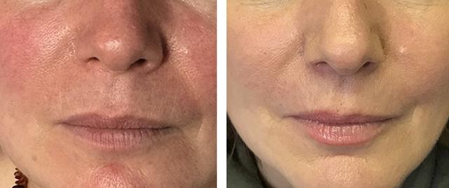Before and after lip enhancements