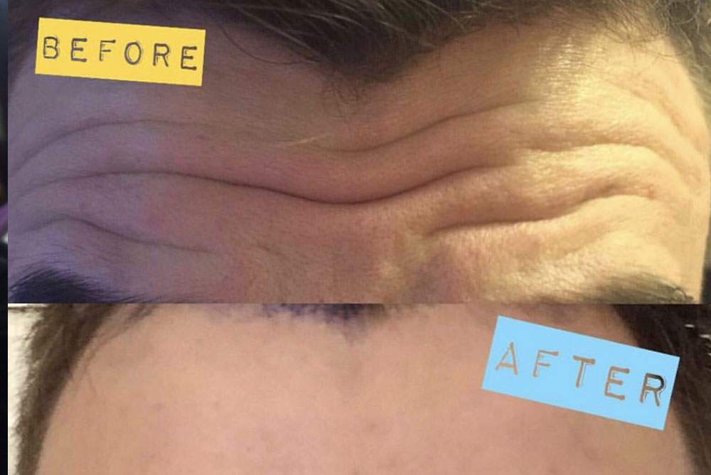 before and after wrinkle reducing injection