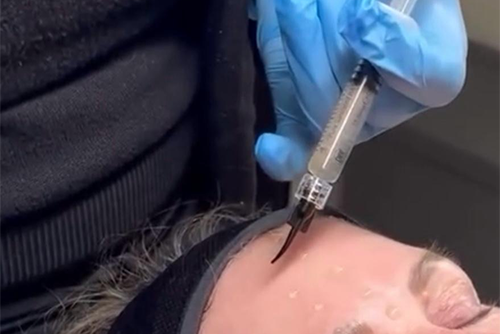 Acupuncture helping with fertility