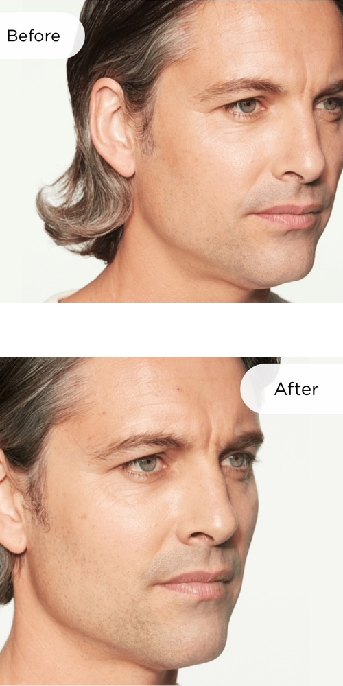 Sculptra before and after
