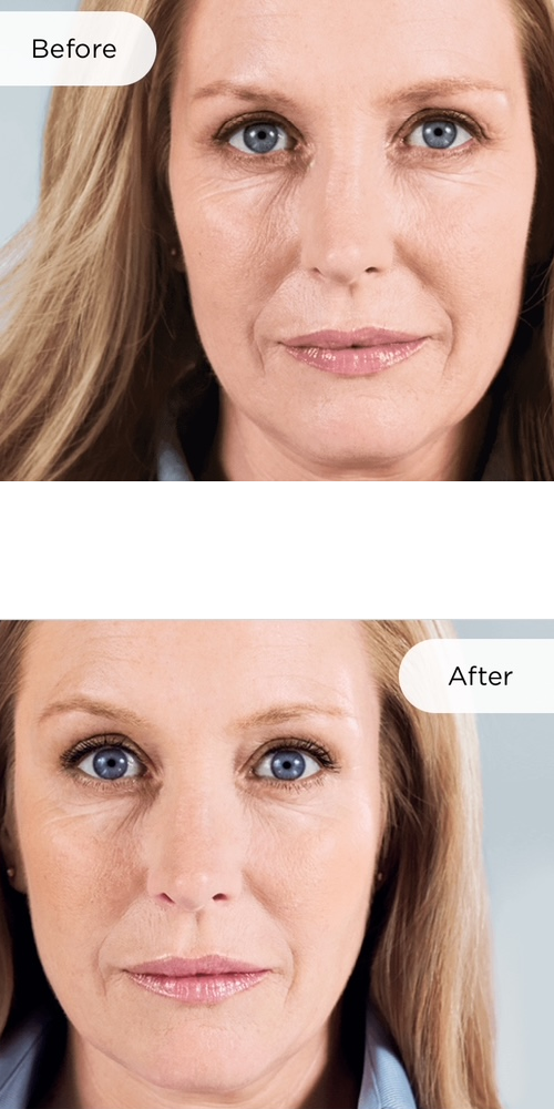Sculptra client