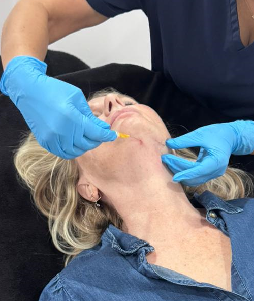 Sculptra therapist