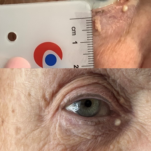 Skin tag treated with cryotherapy